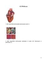 Реферат 'Hipertrofiskā kardiomiopātija', 17.