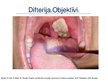Презентация 'Angīnu diferenciāldiagnostika: angīna/difterija', 21.