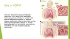 Презентация 'Hroniska obstruktīva plaušu slimība (HOPS)', 3.