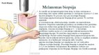 Презентация 'Melanomas biopsija, pataloģija', 9.