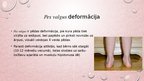 Презентация 'Kāju un pēdu deformācijas. Ārstēšana, fizioterapija', 6.
