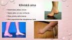 Презентация 'Kāju un pēdu deformācijas. Ārstēšana, fizioterapija', 14.