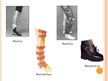 Презентация 'Ortozēšanas iespējas apakšstilba kaulu osteomielīta izraisīto ortopēdisko traucē', 10.