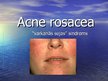 Презентация 'Acne Rosacea', 1.