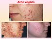 Презентация 'Patstāvīgais darbs ādas slimībās. Acne vulgaris', 3.