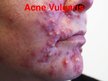 Презентация 'Patstāvīgais darbs ādas slimībās. Acne vulgaris', 4.