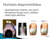 Презентация 'Korsete - palīglīdzeklis idioptiskās skoliozes ārstēšanai pusaudžu vecumā', 10.