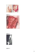 Реферат 'Pēc A.femoralis aneirismas protezēšanas iegūtās infekcijas pacientiem', 18.