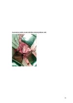 Реферат 'Pēc A.femoralis aneirismas protezēšanas iegūtās infekcijas pacientiem', 21.