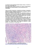 Реферат 'Bezpigmenta melanoma', 13.