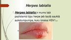 Презентация 'Herpes vīruss', 6.
