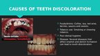 Презентация 'Professional Teeth Bleaching', 4.