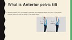 Презентация 'Anterior Pelvic Tilt', 2.