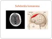 Презентация 'Centrālās nervu sistēmas traumatiski bojājumi', 16.