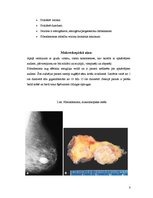 Конспект 'Fibroadenoma. Fibrocistiska krūts slimība', 8.