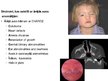 Презентация 'Ģenētiskie sindromi, kuriem raksturīgi kurlums un auss anomālijas', 10.