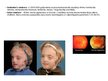 Презентация 'Ģenētiskie sindromi, kuriem raksturīgi kurlums un auss anomālijas', 16.