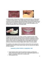 Конспект 'Izņemamās zobu protēzes balstītas, uz implantiem', 13.