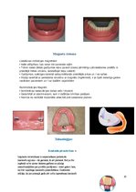 Конспект 'Izņemamās zobu protēzes balstītas, uz implantiem', 20.