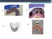 Конспект 'Izņemamās zobu protēzes balstītas, uz implantiem', 40.