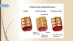 Презентация 'Crohn's Disease', 2.