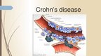 Презентация 'Crohn's Disease', 4.