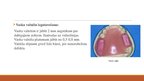 Презентация 'Izņemamās parciālās zobu protēzes ar plastmasas bāzi izgatavošanas klīniskie, la', 14.