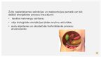Презентация 'Aknu pamatfunkciju traucējumi: Žults veidošanās un izdales traucējumi', 13.