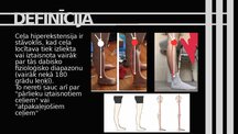 Презентация 'Ceļa hiperekstensija', 2.