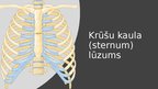 Презентация 'Iegurņa kaula lūzumi, iegurņa stabilizācijas tehnikas. Krūšu kurvja, krūšu kaula', 43.