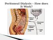 Презентация 'Peritoneal Dialysis', 4.