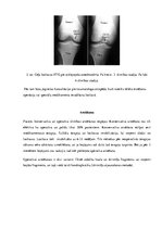 Реферат 'Osteohondritis dissecans jeb atslāņojošais osteohondrīts', 4.