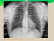 Презентация 'Pacienta aprūpe, veicot krūškurvja rentgenogrammu pie nediagnosticētas plaušu tu', 7.