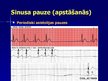 Презентация 'EKG pamati, dzīvībai bīstamie ritmi', 19.