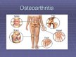 Презентация 'Osteoarthritis', 1.