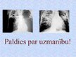 Презентация 'Tuberkuloze', 20.