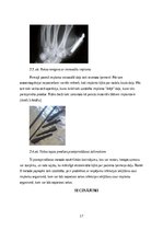 Реферат 'Roku protēzes', 18.